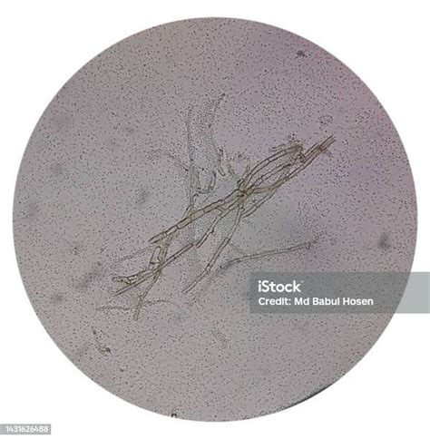 Microscopic Fungi Malassezia Furfur Showing Yeast Cells And Hyphae They Are Associated With