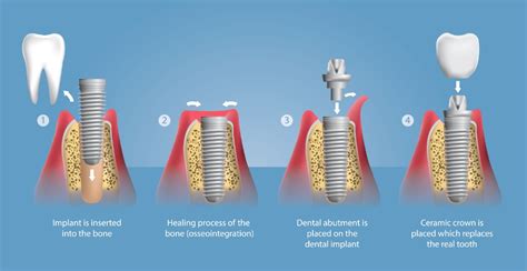 How Long Does a Dental Implant Procedure Take? | Sydney CBD Dentistry