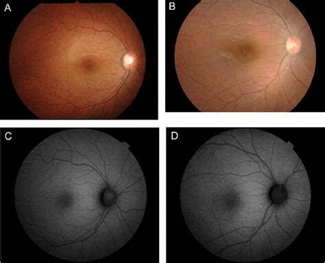 Fundus Photographs And Autofluorescence Images From A Patient With Mild