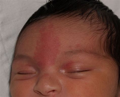 Nevus Simplex Newborn