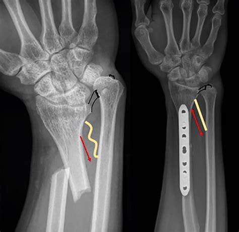 Distal Radioulnar Joint Instability And Galeazzi Fractures Clinical Tree