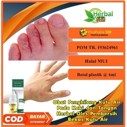 Jual Obat Penghilang Kutu Air Pada Kaki Dan Tangan Herbal Oles