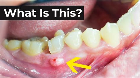 What Is An Abscessed Tooth And What To Do About It Youtube