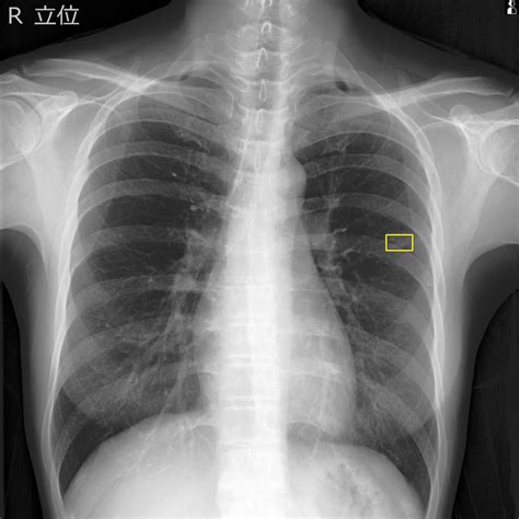 Eirl Chest Nodule Eirlエイル Ai画像診断支援技術 エルピクセル株式会社