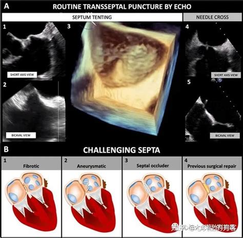 房间隔穿刺 解剖技术并发症及挑战 知乎