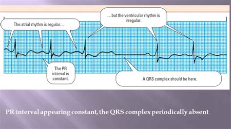 How To Read A Paediatrics Ecg Youtube