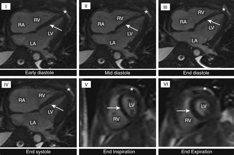 Abnormal Motion Patterns Of The Interventricular Septum JACC