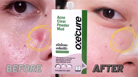 Effective Sa Pimples To Only P89 00 Oxecure Acne Clear Powder Mud