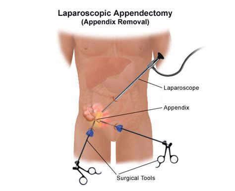 Laparoscopic Appendectomy Video