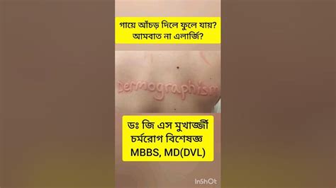 Allergy Urticaria Dermographism Dermatologist Shorts Doctor Health Bangla