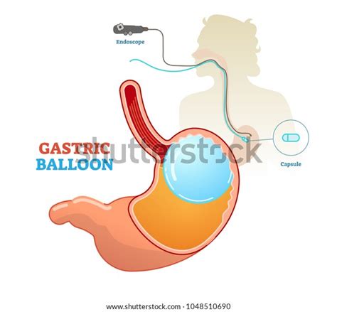 Gastric Balloon Medical Procedure Concept Diagram Stock Vector (Royalty ...