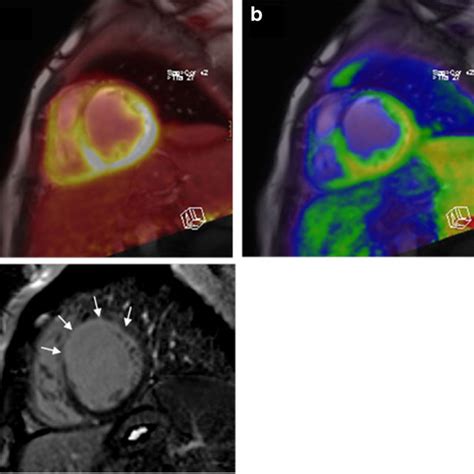 Cardiac Pet Mri Of A Year Old Male Patient With Advanced Coronary