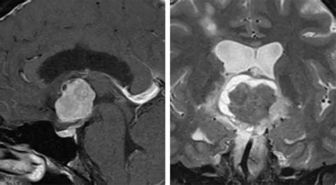 脑室内肿瘤手术策略与技巧 The Neurosurgical Atlas全文翻译 脑医汇 神外资讯 神介资讯