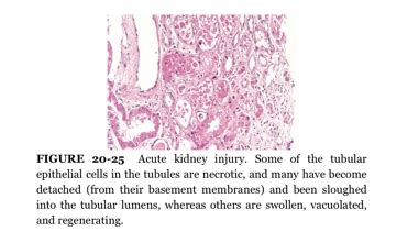 Urinary pathology: acute tubular necrosis (ATN) and renal papillary ...