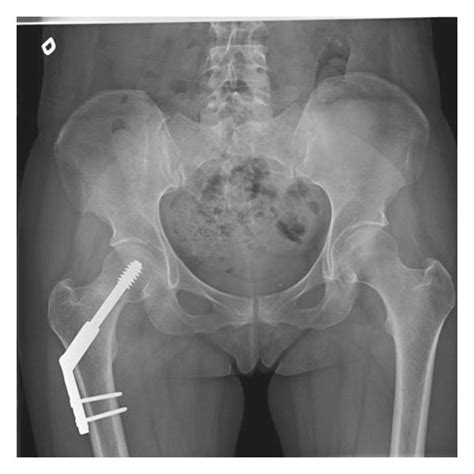 A AP Pelvic X Ray And B Lateral View Of The Right Hip After Dynamic