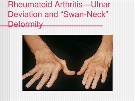 Swan Neck Deformity Psoriatic Arthritis