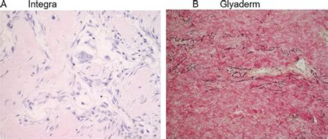 A Presence Of Multi Nucleated Giant Cells With Integra B In The