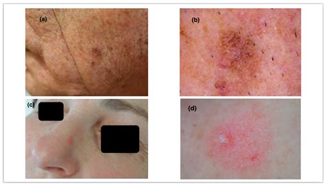 Dermoscopy Of Actinic Keratosis Is There A True Differentiation