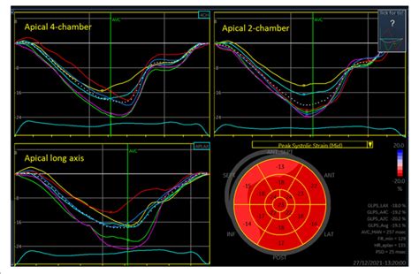 Three Plane Longitudinal Strain Analysis Of The Left Ventricle Each