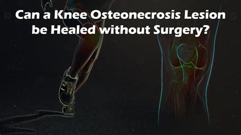 Healing Spontaneous Osteonecrosis Of The Knee Without Surgery