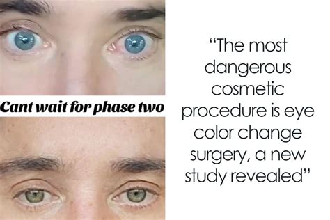 Patients Increasingly Changing Eye Color With Surgery Despite Over 90% ...