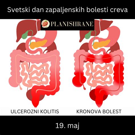 Zapaljenske Bolesti Creva Ulcerozni Kolitis I Kronova Bolest Plan