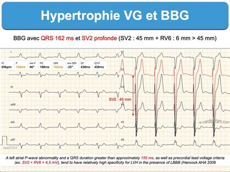 Bloc De Branche 3 Gauche Complet E Cardiogram