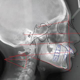 Cephalometric Tracing T A Cephalometric Evaluation Of The Lateral