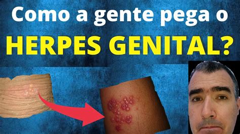 Imagens De Herpes Genital RETOEDU