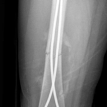 2 90-90 traction is considered for 14-21 days in length-unstable ...