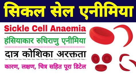 सिकल सेल एनीमिया Sickle Cell Anemia In Hindi Sickle Cell Anemia