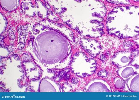 Benign Prostatic Hyperplasia Stock Image Image Of Morphology Cell