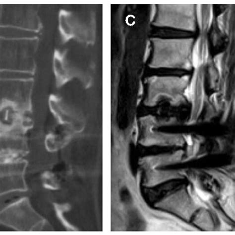 Images Obtained In A 62 Year Old Woman Who Had An L4l5 Posterior Download Scientific Diagram