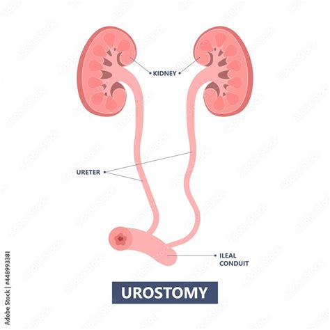 Tube Stent bag blocked kidney stone tumor urine urinary Drain renal ...