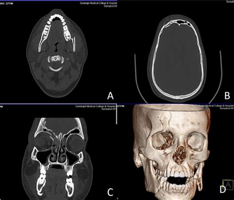 A & B. Axial images demonstrate the fracture of left half of mandible ...