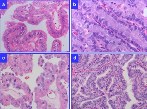 Histological Variants Of Metastatic Papillary Thyroid Carcinoma Ptc