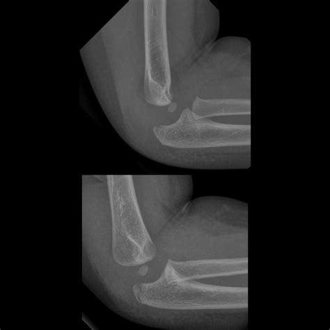 Pediatric Elbow Fracture | Pediatric Radiology Reference Article | Pediatric Imaging | @pedsimaging