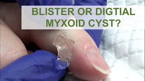 Digital Myxoid Cyst Causes Symptoms Diagnosis Treatme - vrogue.co