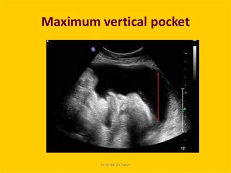 14 Amniotic Fluid Imaging Dr Ahmed Esawy