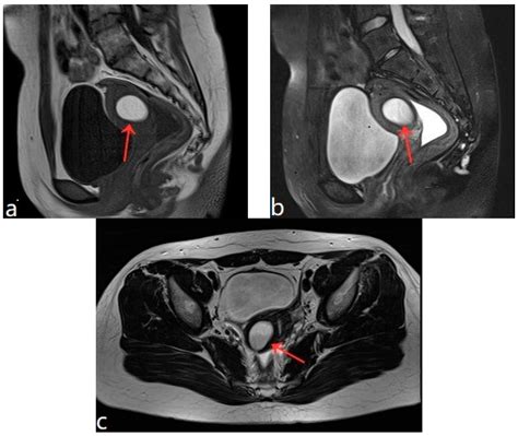 Doctors reveal the secret behind biggest cysts popped clips 16