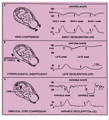 What Causes Early Decelerations