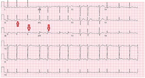 A 12 Lead Electrocardiograph Showing St Segment Elevation In Leads Ii