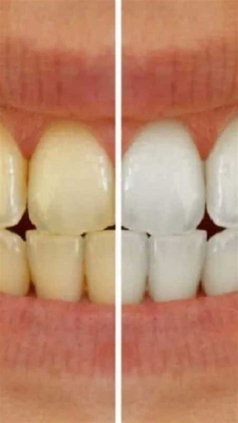 how to get rid of black spots on teeth