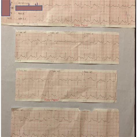 The Lead Electrocardiography Ecg Showed Wide Spread St Depression