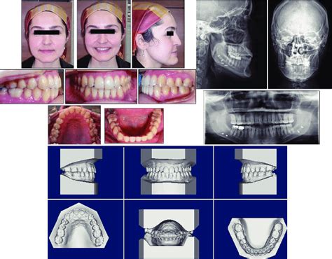 Post Retention Facial And Intraoral Photographs Dental Casts And Download Scientific Diagram