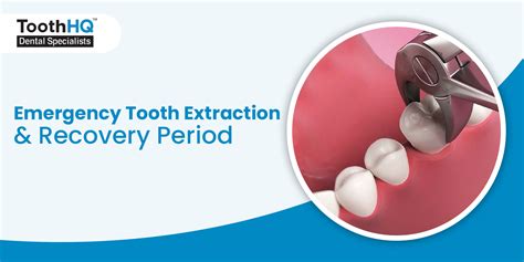 Emergency Tooth Extraction & Recovery Period - ToothHQ Dental Specialists