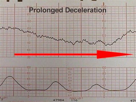 Electronic Fetal Heart Monitoring