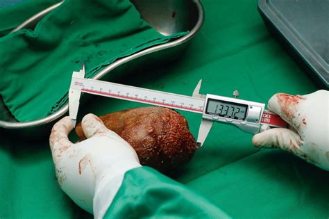 Sri Lanka Doctors Remove World S Largest Kidney Stone The Star