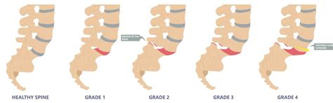 Grades Of Anterolisthesis Understanding Severity And Its Impact On