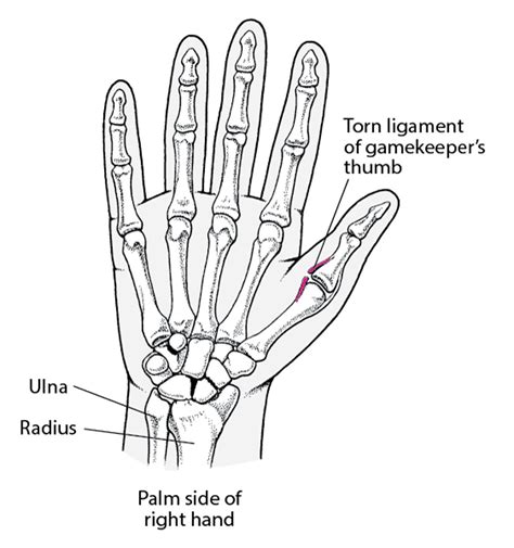 Thumb Sprains - Injuries and Poisoning - Merck Manual Consumer Version